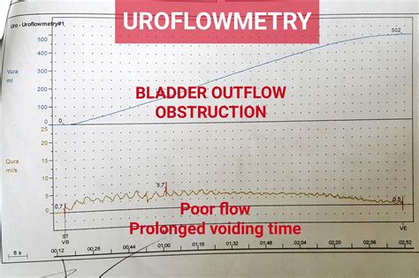 uroflow pvr|how to read uroflow.